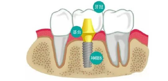 口腔种植牙详细介绍,患者再问用它! 口腔种植牙详细介绍,患者再问用它!