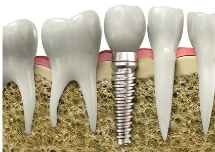 口腔种植牙详细介绍,患者再问用它! 口腔种植牙详细介绍,患者再问用它!