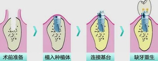 口腔种植牙详细介绍,患者再问用它! 口腔种植牙详细介绍,患者再问用它!