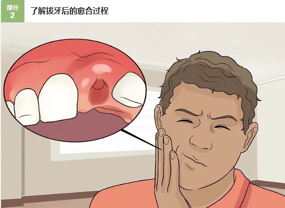 拔牙后，如何促进牙龈伤口愈合？—义乌傅氏口腔
