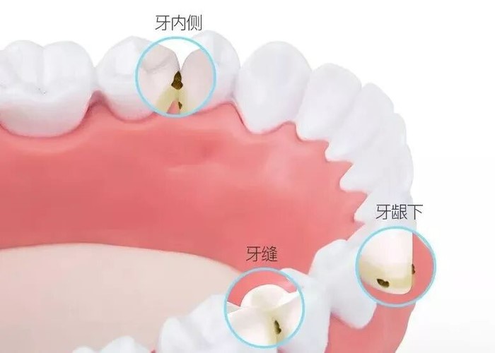 牙齿敏感怎么预防？—义乌口腔护理