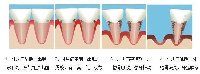 想种牙先治好牙周病！—义乌种植牙