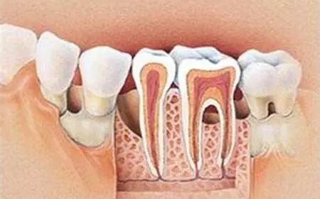 想种牙先治好牙周病！—义乌种植牙