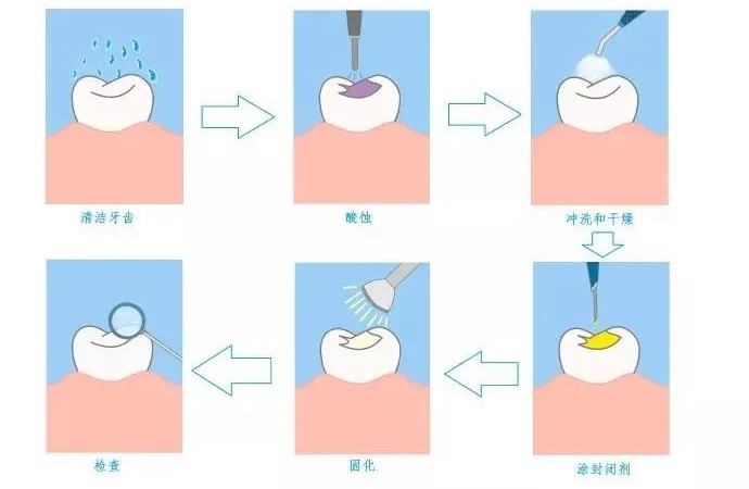 儿童窝沟封闭、涂氟后就不再长龋齿了？