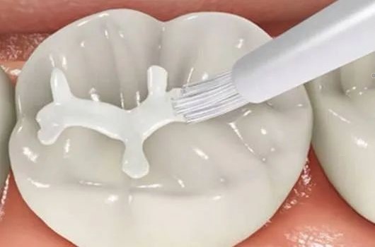 儿童窝沟封闭、涂氟后就不再长龋齿了？