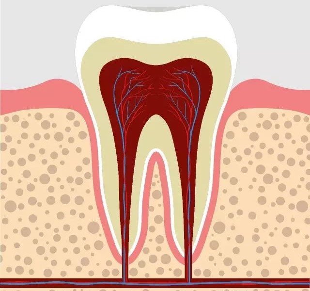 智齿碰上急性牙髓炎，直接拔还是开髓后拔？