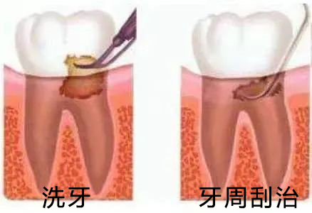 洗牙与牙周刮治的区别！