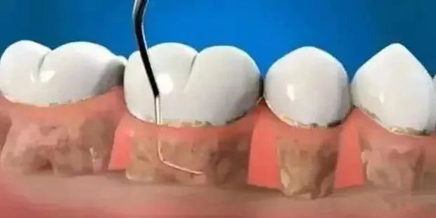 洗牙与牙周刮治的区别！