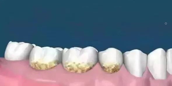 洗牙与牙周刮治的区别！