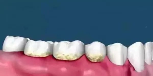 洗牙与牙周刮治的区别！