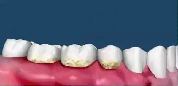 洗牙与牙周刮治的区别！