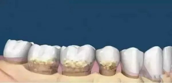 洗牙与牙周刮治的区别！