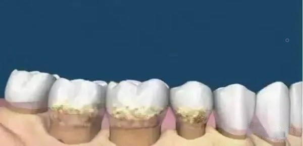 洗牙与牙周刮治的区别！