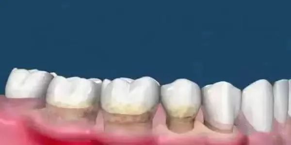 洗牙与牙周刮治的区别！