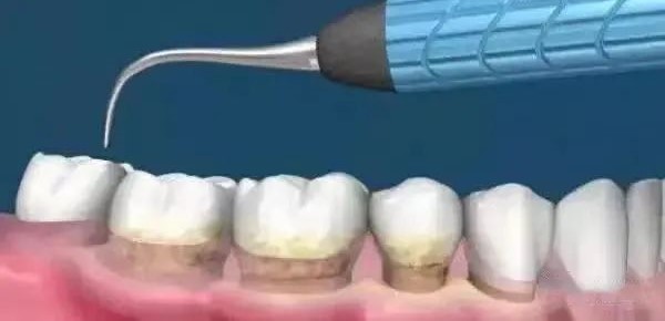 洗牙与牙周刮治的区别！