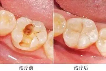 真牙的“救命稻草”根管治疗，八大问题解答！—义乌傅氏口腔