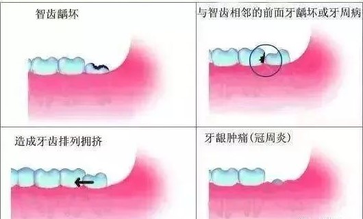 智齿总是发炎，什么时候拔掉才好？—义乌傅氏口腔