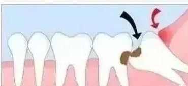 智齿总是发炎，什么时候拔掉才好？—义乌傅氏口腔