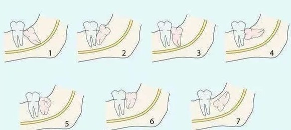 智齿总是发炎，什么时候拔掉才好？—义乌傅氏口腔
