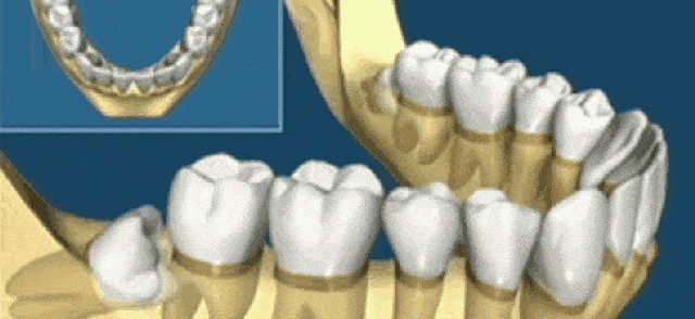 智齿有这六种情况，疼不疼都得拔！—义乌傅氏口腔