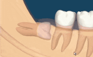 智齿有这六种情况，疼不疼都得拔！—义乌傅氏口腔