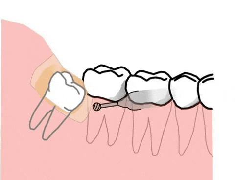 智齿有这六种情况，疼不疼都得拔！—义乌傅氏口腔