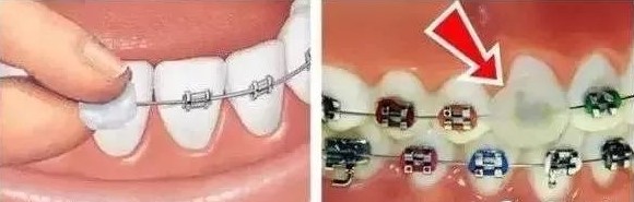 正畸保护蜡的使用方法