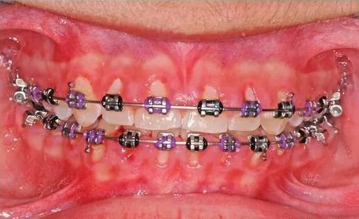 牙龈炎，典型表现为牙龈边缘红肿，刷牙出血。