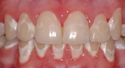 牙釉质脱矿，典型表现为托槽周围牙冠表面白垩色斑块。