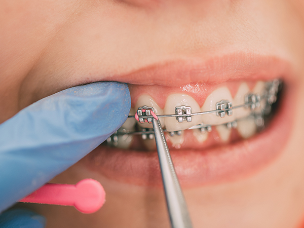 什么时候进行正畸治疗最合适？—义乌牙齿矫正