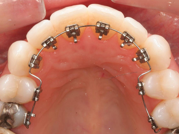 什么时候进行正畸治疗最合适？—义乌牙齿矫正