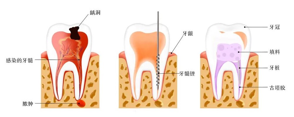 牙疼睡不着怎么办？