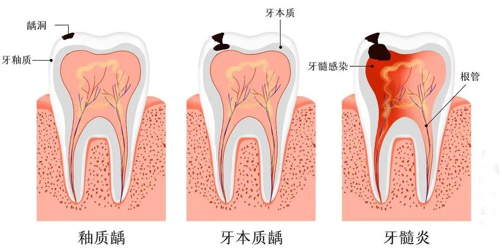 牙疼睡不着怎么办？
