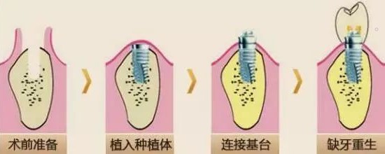 如何让种植牙用得更久? 如何让种植牙用得更久?