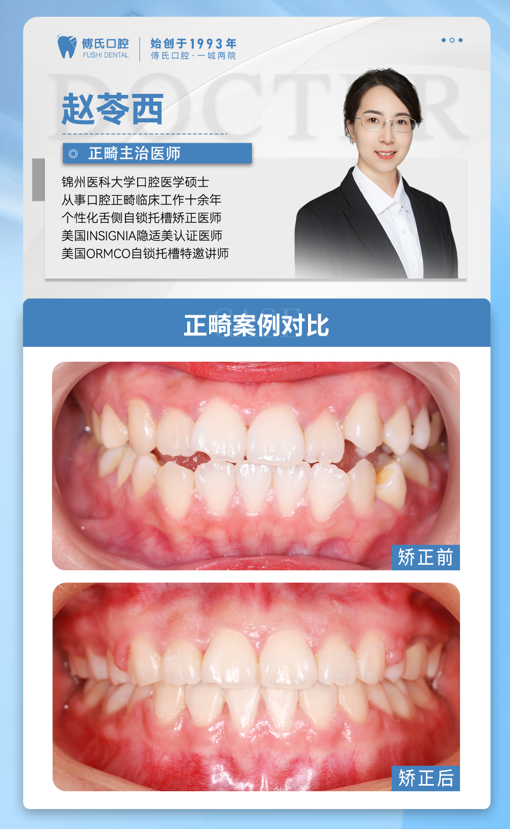 义乌傅氏口腔前牙开合，嘴凸，下巴后缩矫正案例分享！