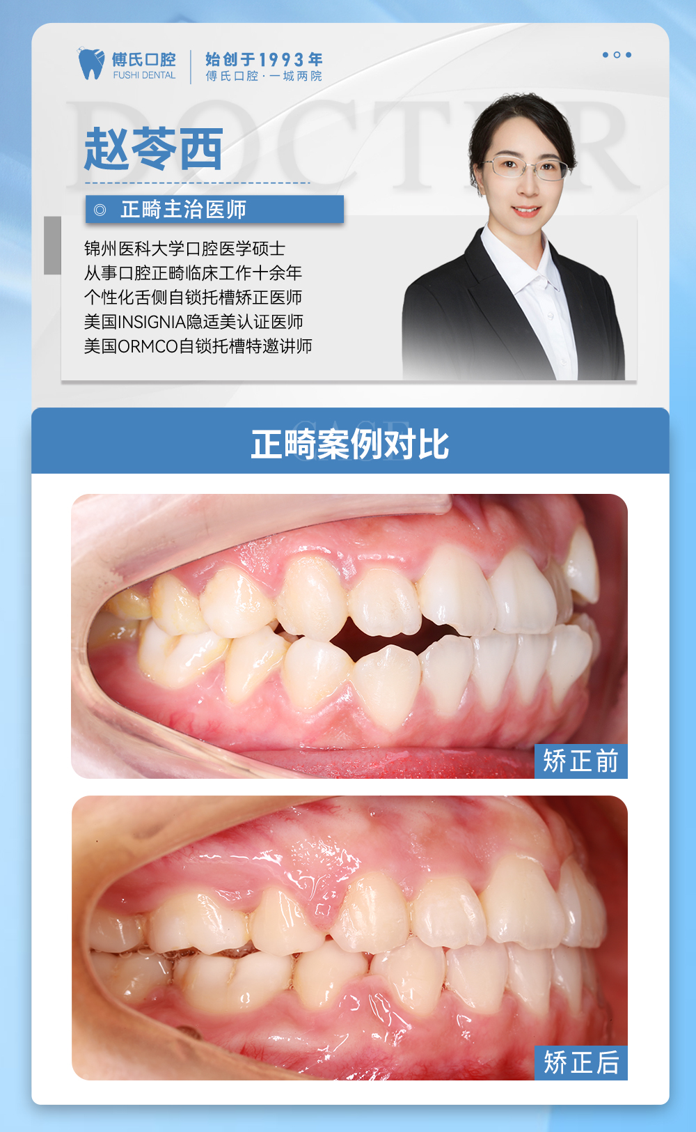 义乌傅氏口腔前牙开合，嘴凸，下巴后缩矫正案例分享！