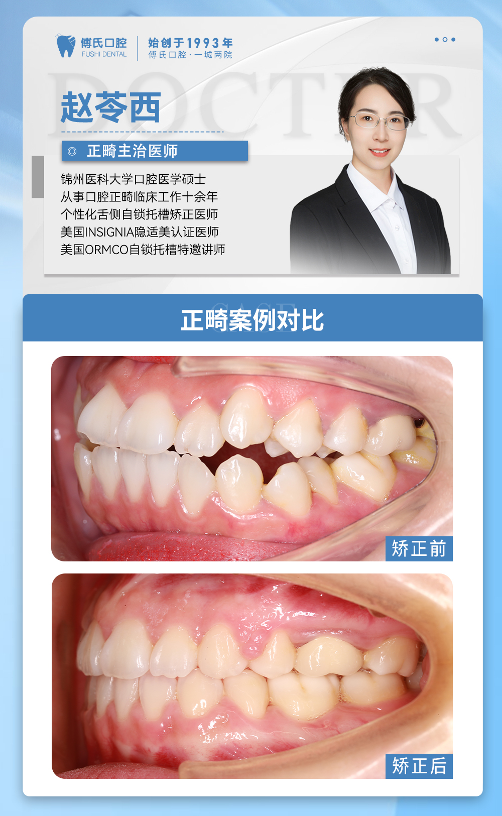 义乌傅氏口腔前牙开合，嘴凸，下巴后缩矫正案例分享！