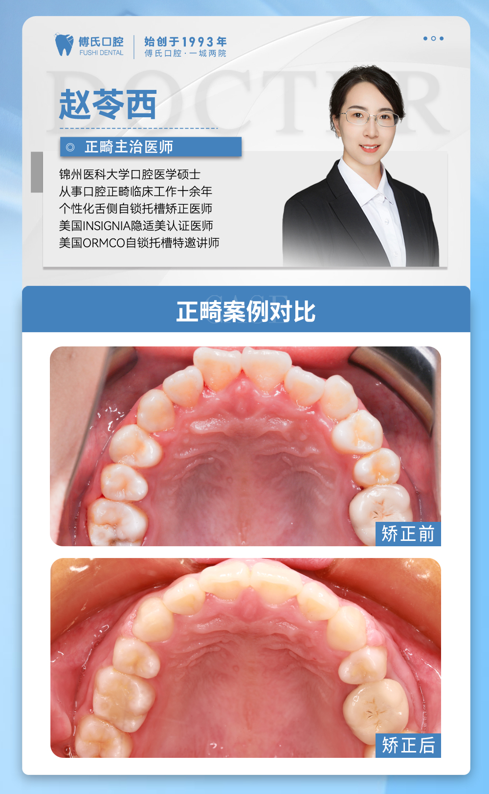 义乌傅氏口腔前牙开合，嘴凸，下巴后缩矫正案例分享！