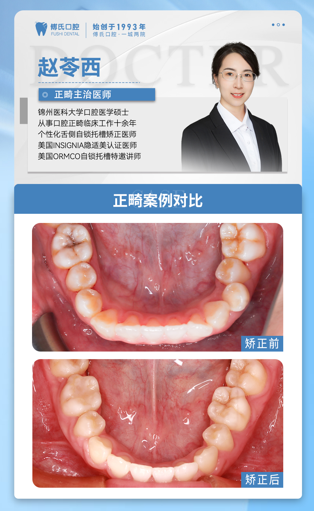 义乌傅氏口腔前牙开合，嘴凸，下巴后缩矫正案例分享！