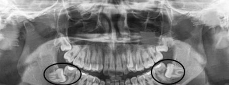 拔智齿的最佳时期! 拔智齿的最佳时期!