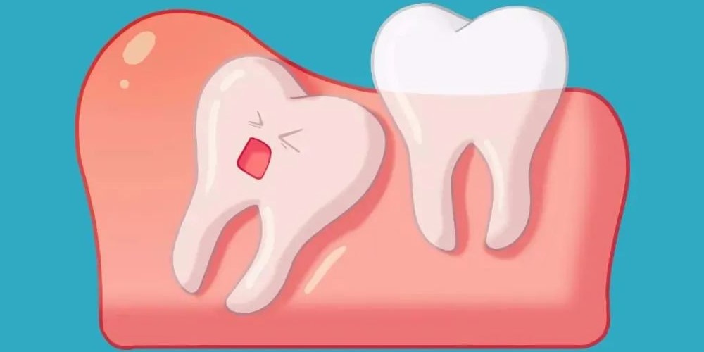 拔智齿的最佳时期! 拔智齿的最佳时期!
