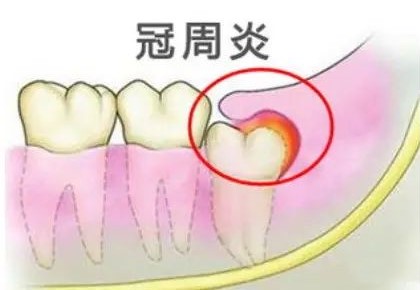 拔智齿的最佳时期! 拔智齿的最佳时期!