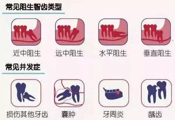 拔智齿的最佳时期! 拔智齿的最佳时期!