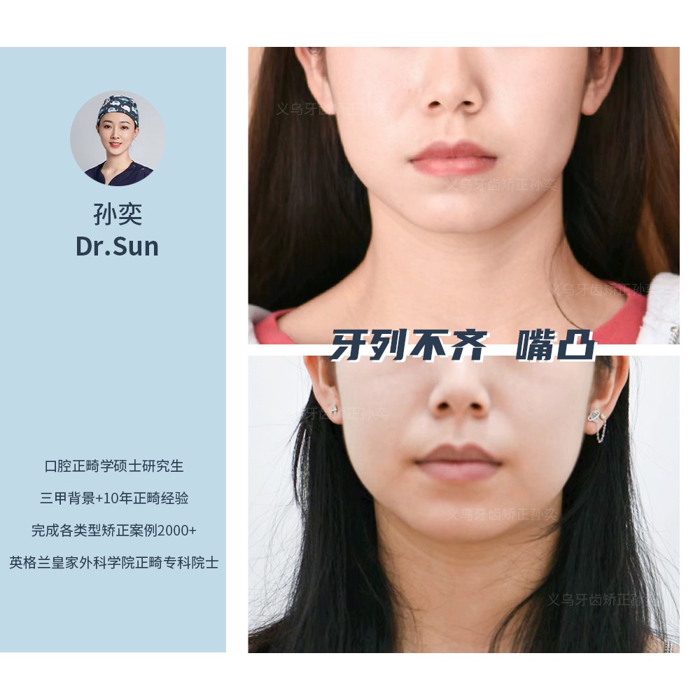 义乌傅氏口腔牙列不齐嘴凸矫正案例分享！