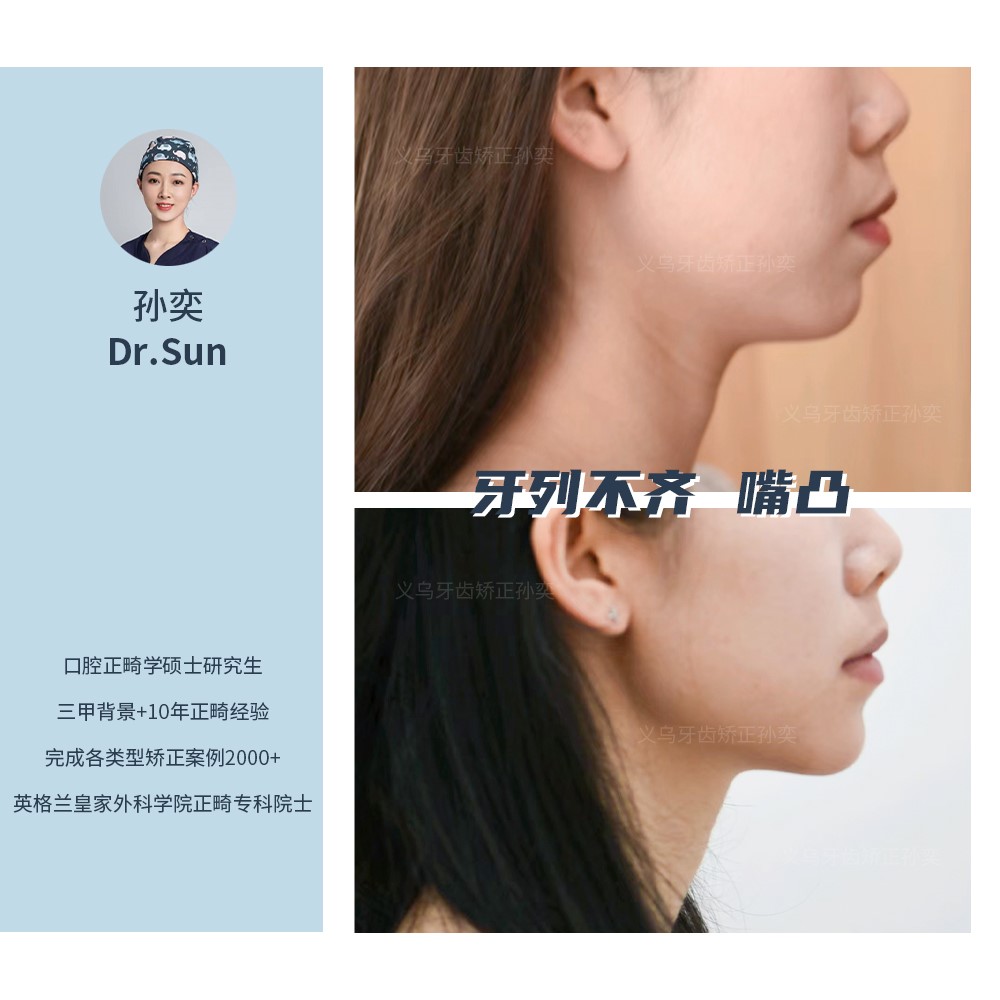 义乌傅氏口腔牙列不齐嘴凸矫正案例分享！