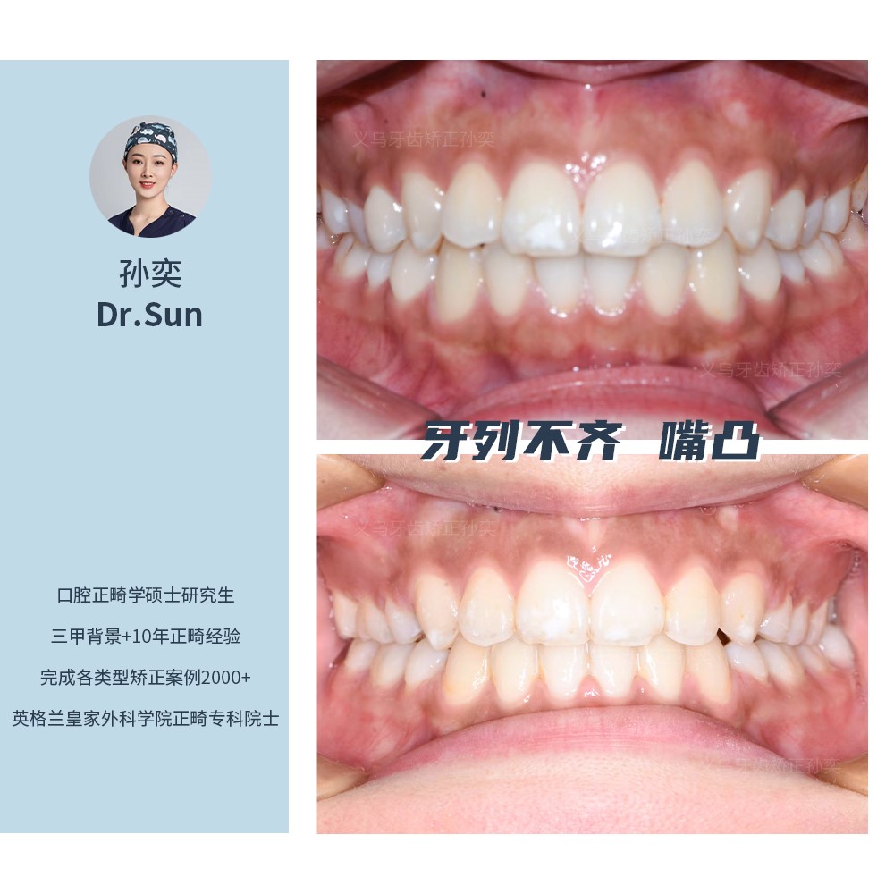 义乌傅氏口腔牙列不齐嘴凸矫正案例分享！