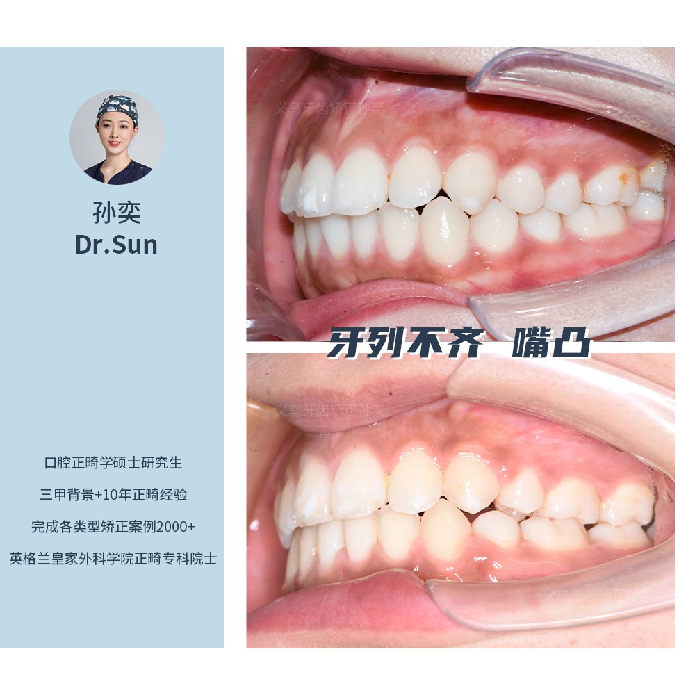 义乌傅氏口腔牙列不齐嘴凸矫正案例分享！