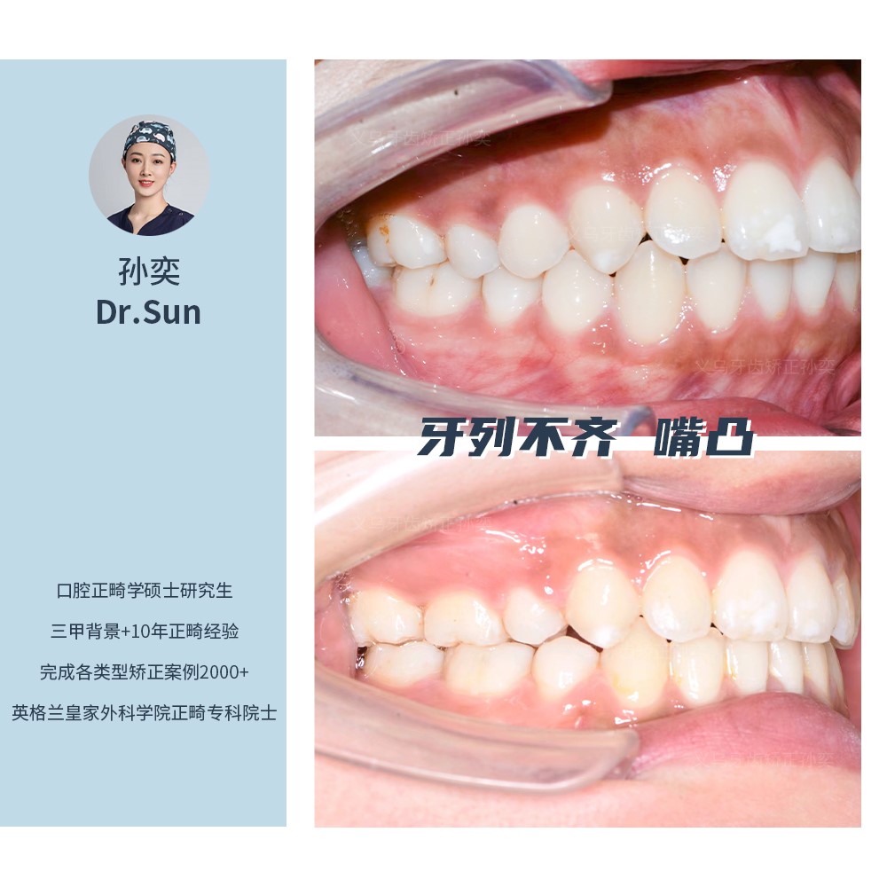 义乌傅氏口腔牙列不齐嘴凸矫正案例分享！