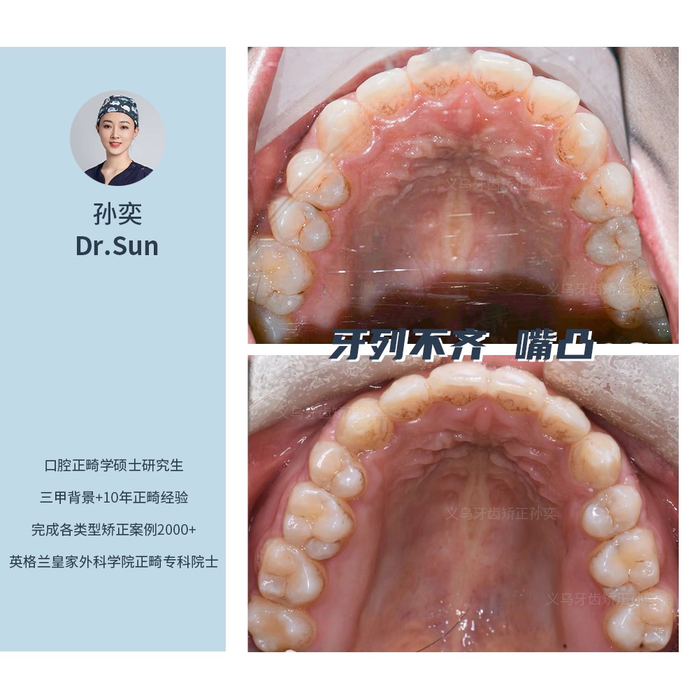 义乌傅氏口腔牙列不齐嘴凸矫正案例分享！