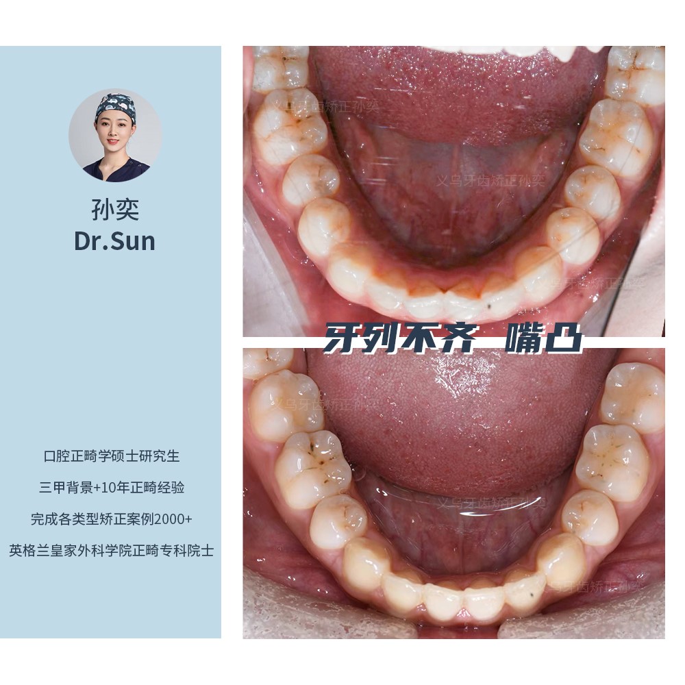 义乌傅氏口腔牙列不齐嘴凸矫正案例分享！